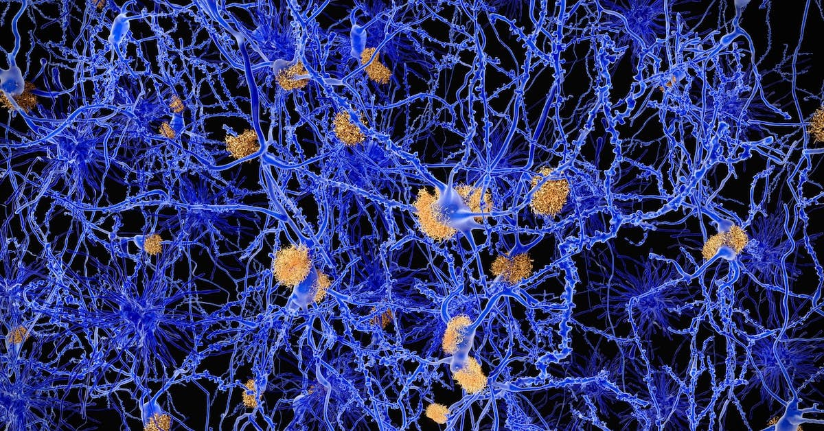 New Discovery Points to an Overlooked Cause of Alzheimer’s about undefined